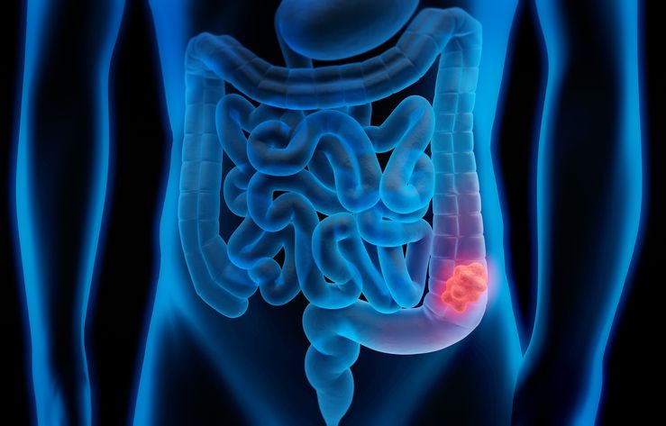 Comprender la metástasis para vencer el cáncer de colon