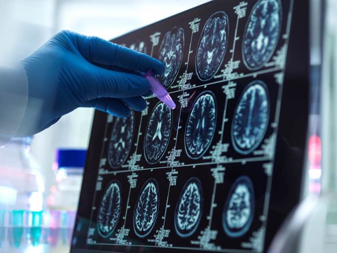 Científicos del CSIC participan en el desarrollo de la escala de riesgo genético más completa para el alzhéimer