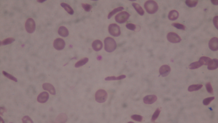 Investigadores de la UIB proponen una nueva metodología de IA para mejorar el diagnóstico de la drepanocitosis